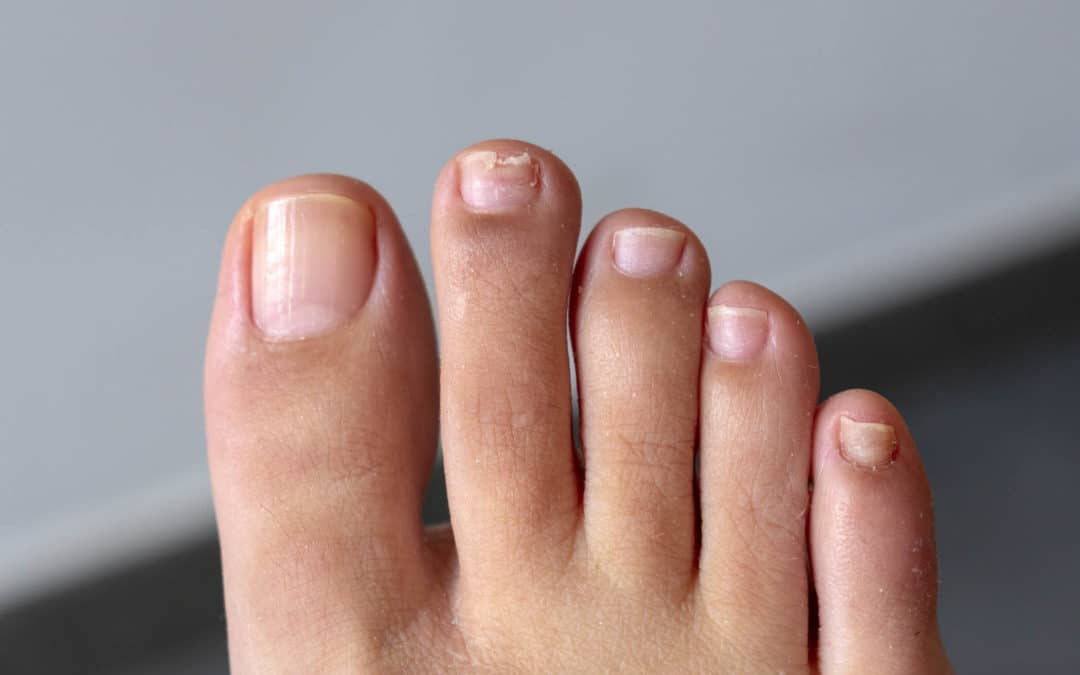 How to Catch Nail Fungus Early