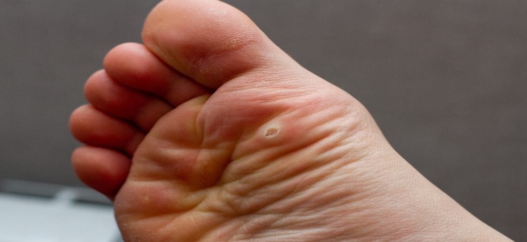 What is the Best Way to Get Rid of Plantar Warts?