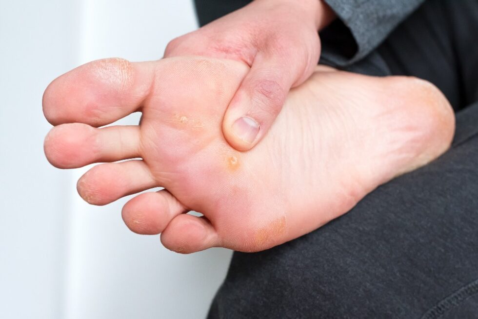 Are Plantar Warts Contagious? Family Foot Care & Surgery