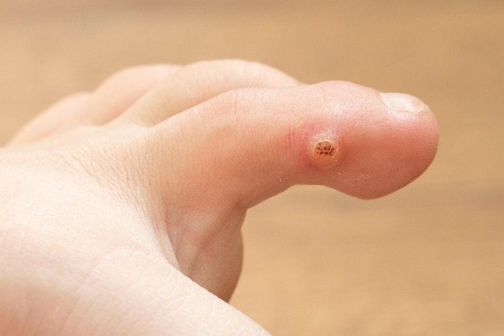 Plantar wart on the middle toe