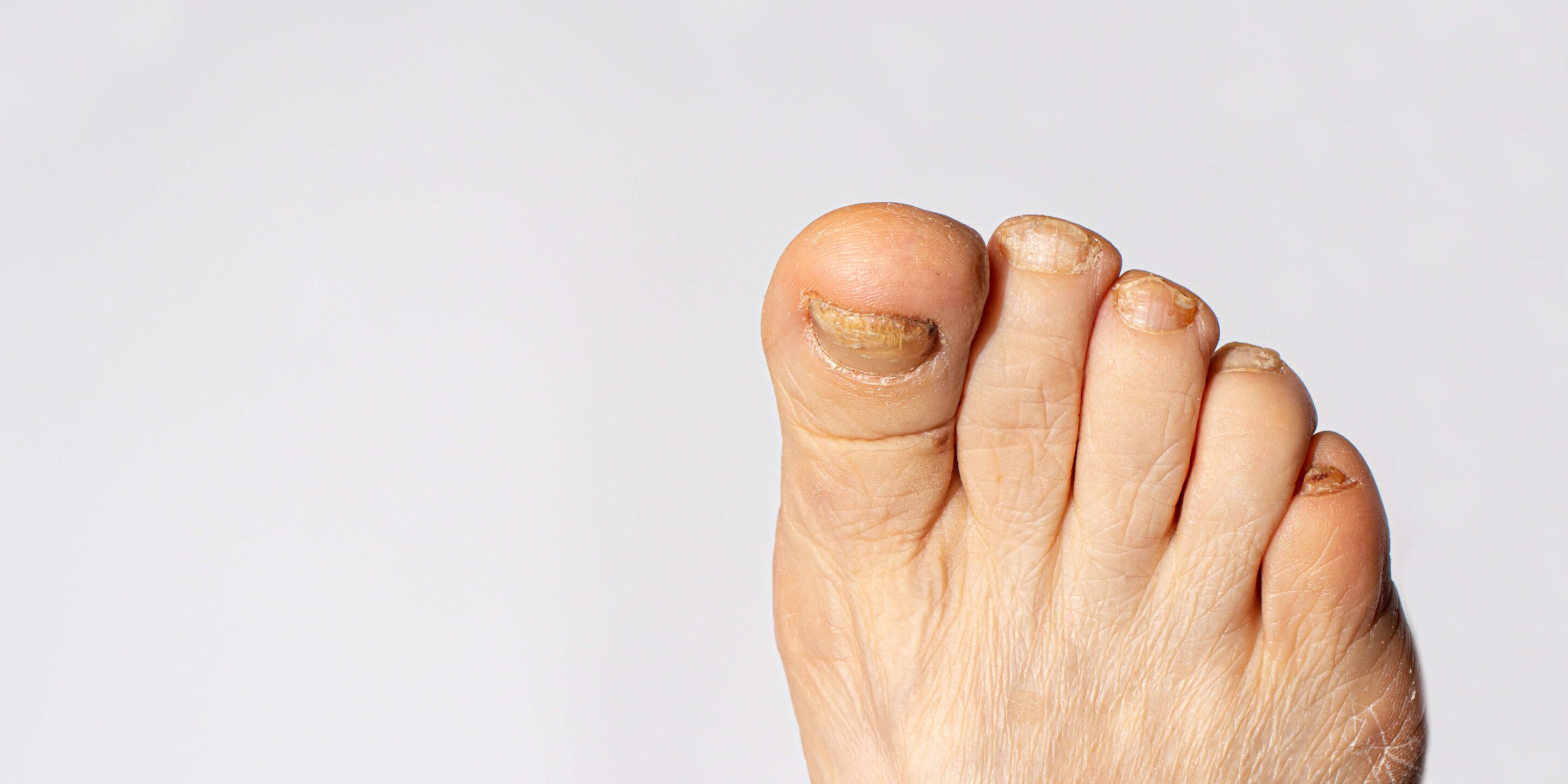 Fungus of nails on the big toe